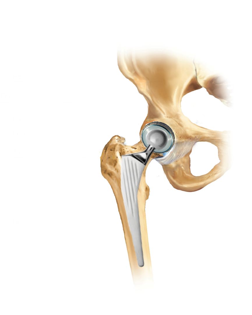 protesi-totale-anca-posizionata-artrosi-
