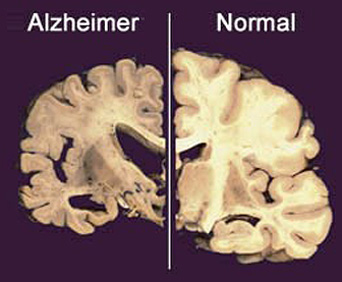 alzheimer-sintomi