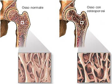 FISIOTERAPIA E RIABILITAZIONE NELL’ OSTEOPOROSI