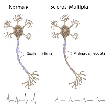 Sclerosi Multipla: un normale antistaminico favorisce la rimielinizzazione