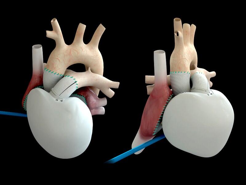 Grazie ad un cuore stampato in 3D è stata salvata la vita ad una bambina di 3 anni