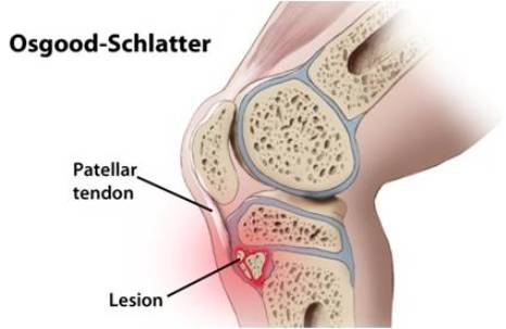 Sindrome di Osgood-schlatter: come curare il ginocchio in bambini e adolescenti