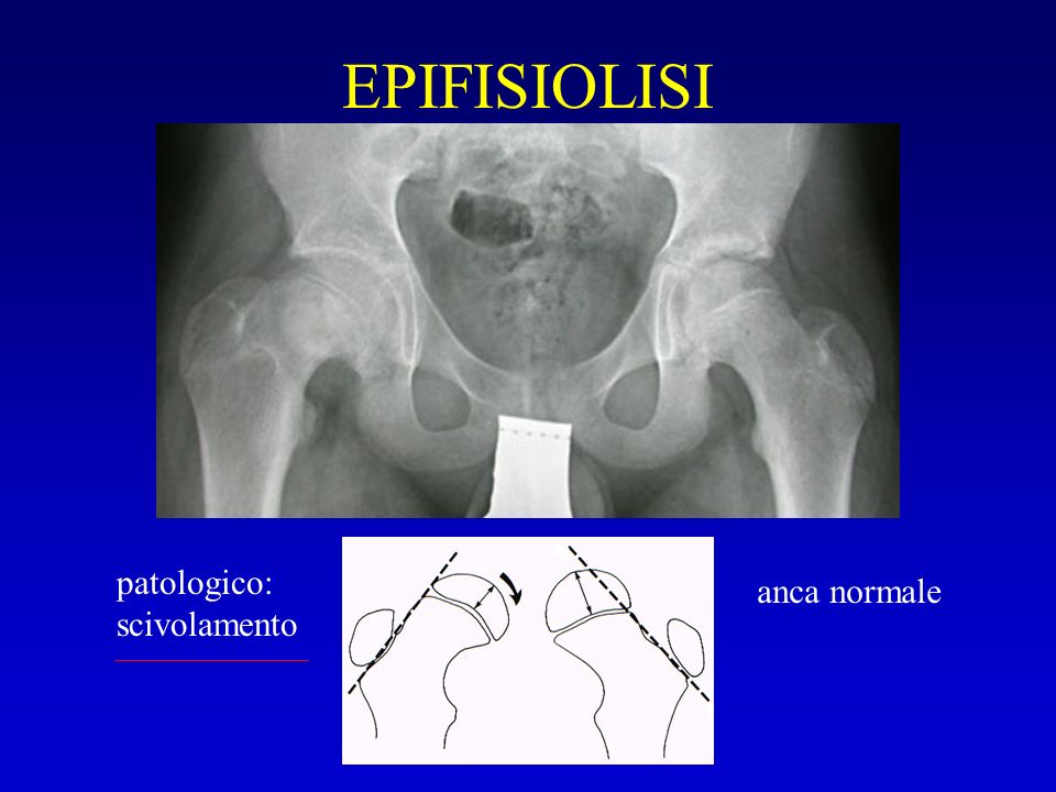 Epifisiolisi dell’ anca