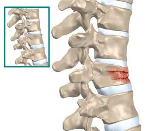 Problemi alle vertebre lombari: traumi, fratture e rimedi