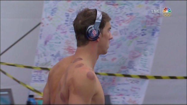Phelps sfodera il cupping, cerchietti rossi alle olimpiadi di Rio