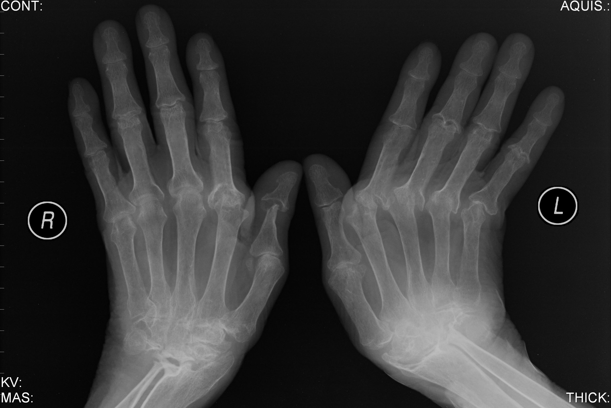 Scoperto «grilletto molecolare»dell’artrite reumatoide