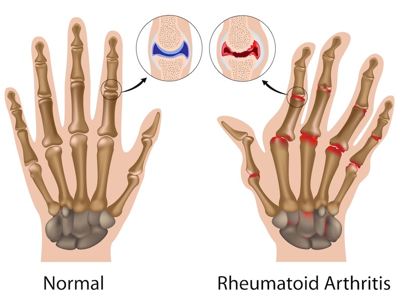 Il trattamento fisioterapico per l’artrite reumatoide