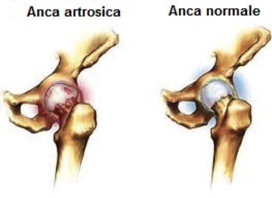 Artrosi dell’anca: fisioterapia o chirurgia?