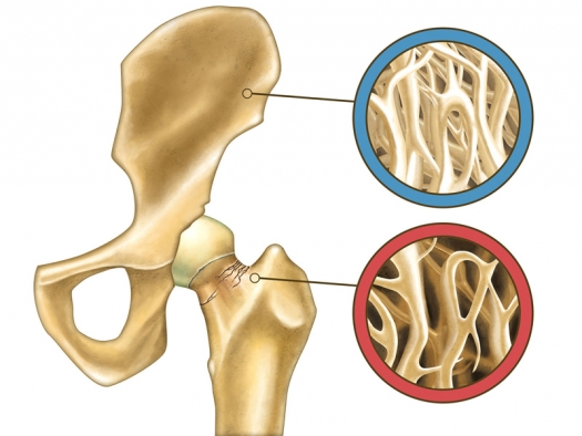 Osteopenia: come agire prima che si trasformi in osteoporosi