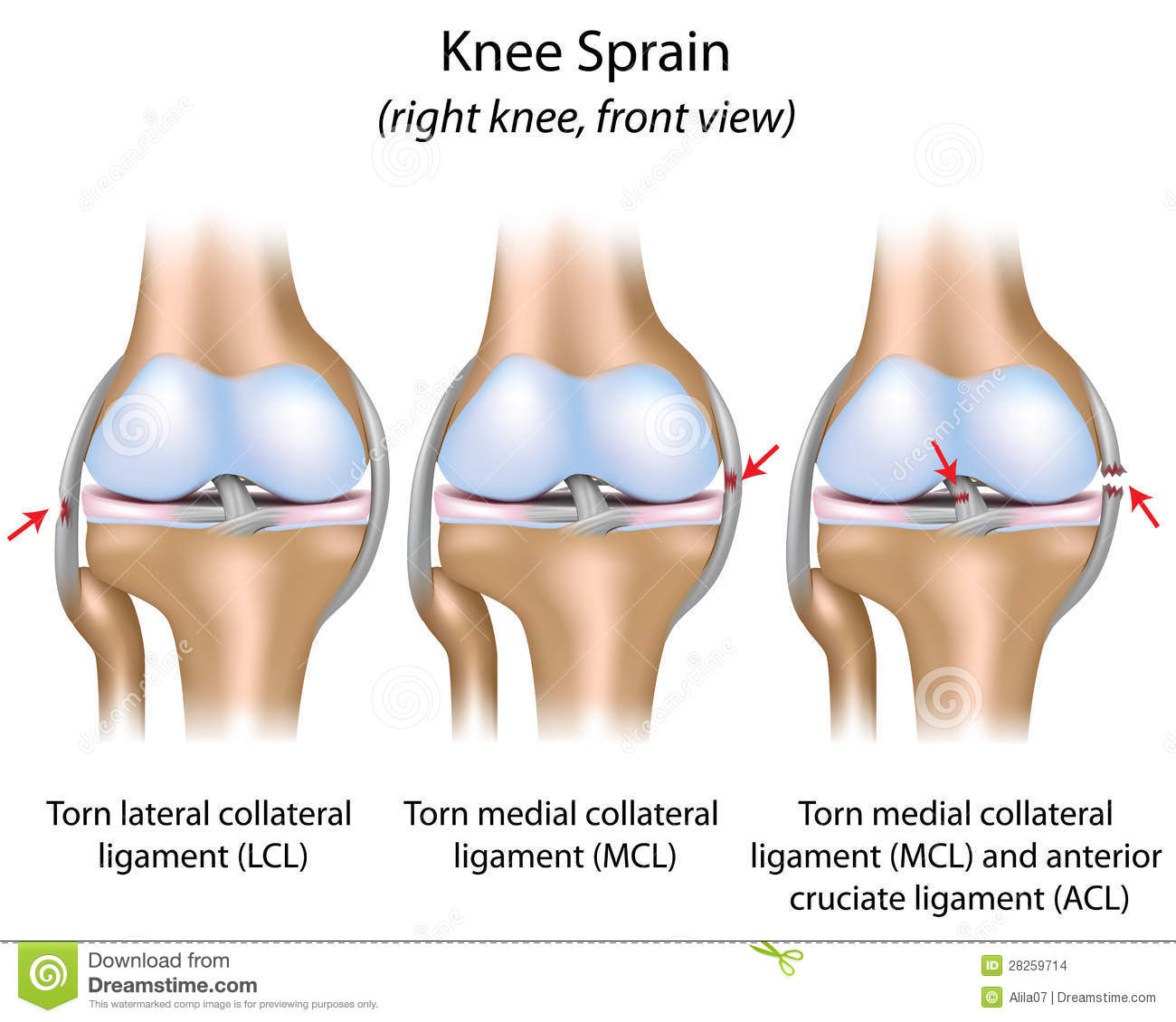Distorsione al ginocchio: sintomi, cosa fare e cura