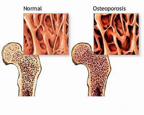 Osteoporosi: il test online che valuta i rischi di frattura