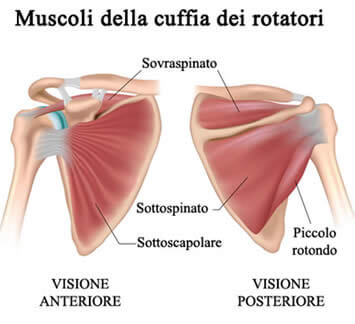 Tendinite del sovraspinoso: sintomi, esercizi, cura, rimedi e riabilitazione