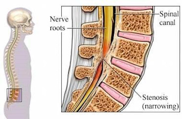 Esercizi utili per la stenosi vertebrale